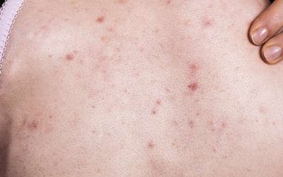 Krioszauna: A bőrproblémák korszerű megoldása Budapesten